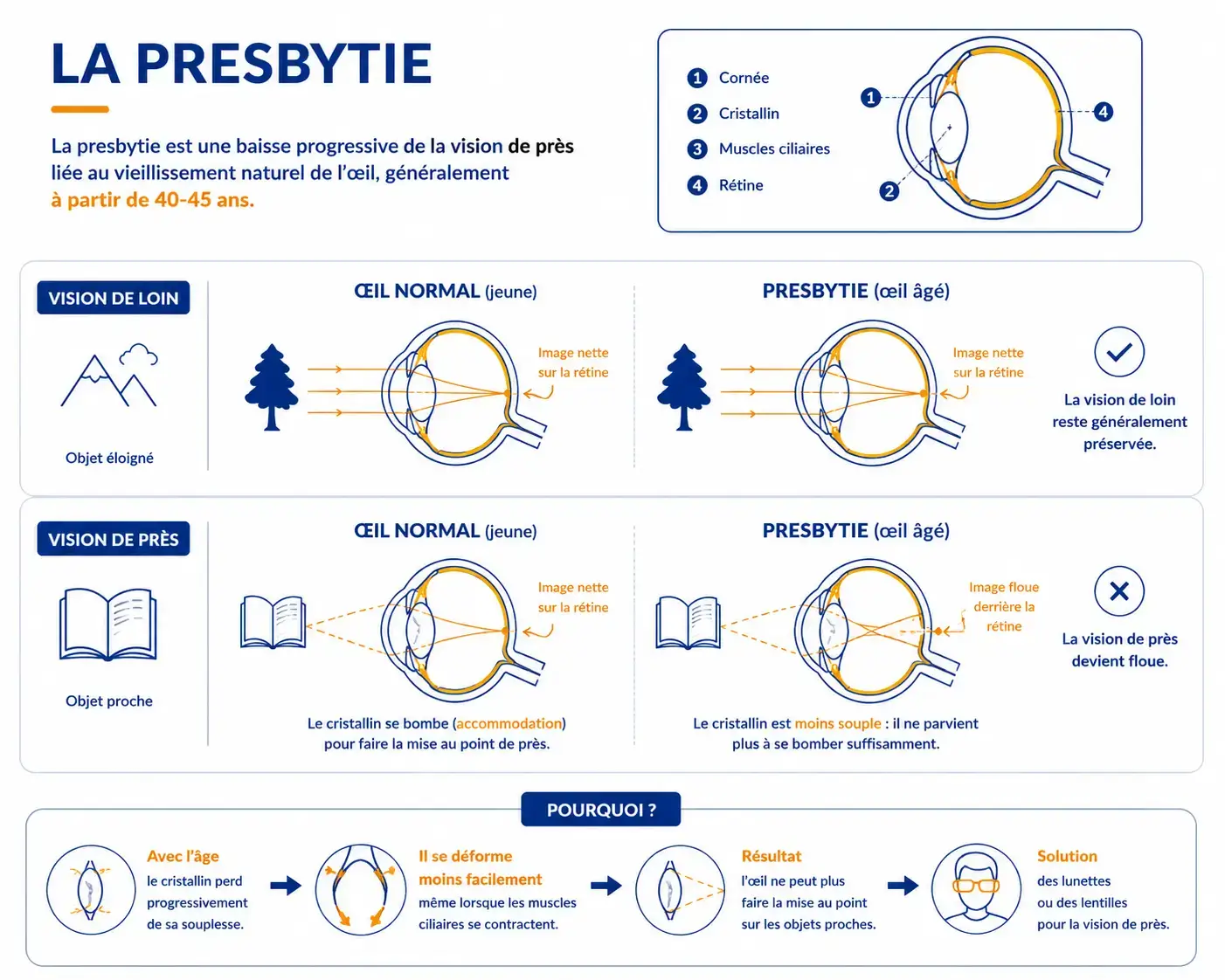 a presbytie affecte la vision de près : avec l'âge, le cristallin perd de sa souplesse et ne parvient plus à faire la mise au point sur les objets proches.